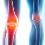 Arthrose: Ursachen, Symptome und moderne Behandlungsmöglichkeiten